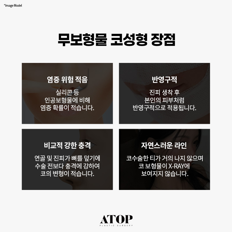 무보형물 코성형 만족도가 떨어질까? 관련 이미지 5