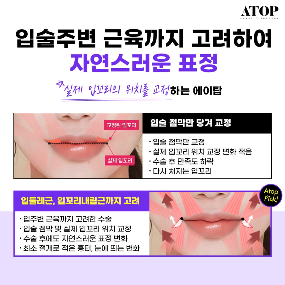 입꼬리수술내돈내산 위치 자체가 교정돼 더 자연스러워 관련 이미지 3