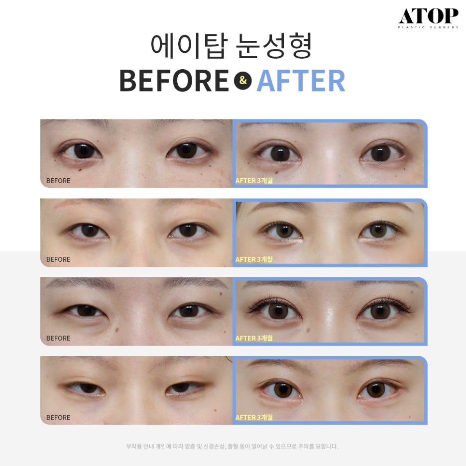 강남쌍수잘하는곳 맞춤 디자인으로 핏하게 관련 이미지 7