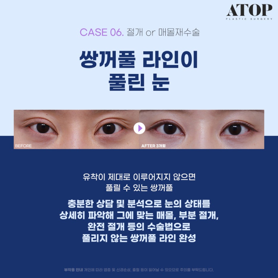 Where to Get Revision Eyelid Surgery Done Well: Surgical Methods Tailored to Eye Type image 7