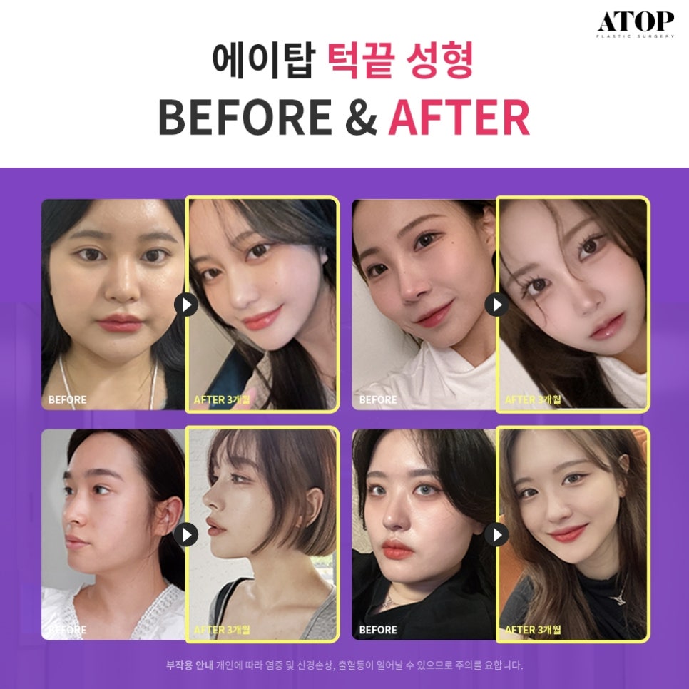 Types of Chin Reduction Surgery: Beautiful Lengthening/Reduction Procedures image 7