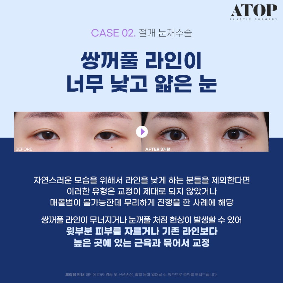 Where to Get Revision Eyelid Surgery Done Well: Surgical Methods Tailored to Eye Type image 3