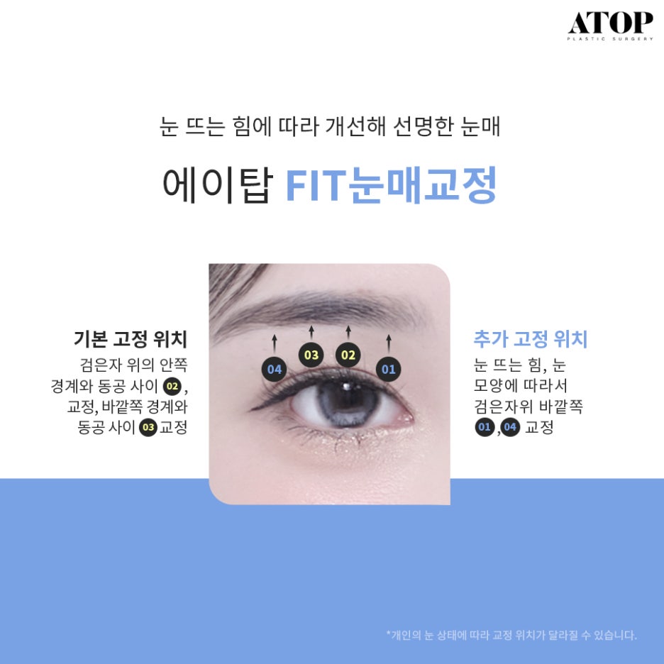 강남쌍수잘하는곳 맞춤 디자인으로 핏하게 관련 이미지 5