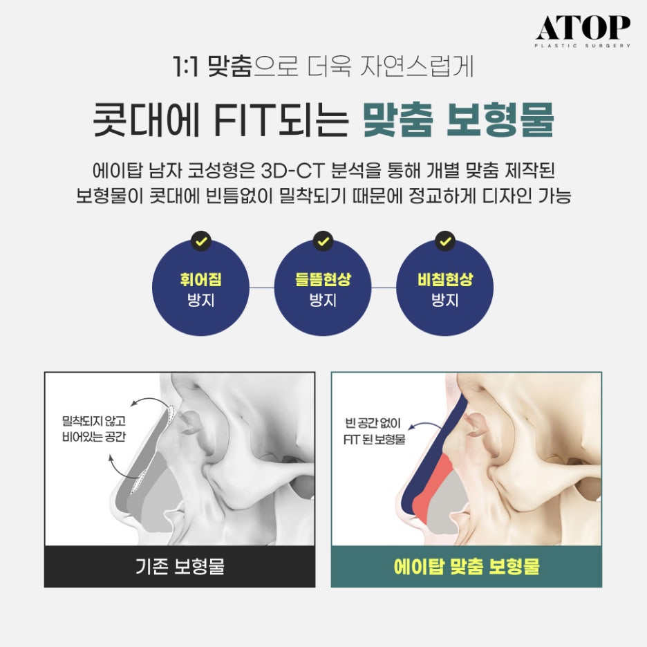Male Nose Surgery Review: A Natural Line That Doesn’t Look Artificial image 6