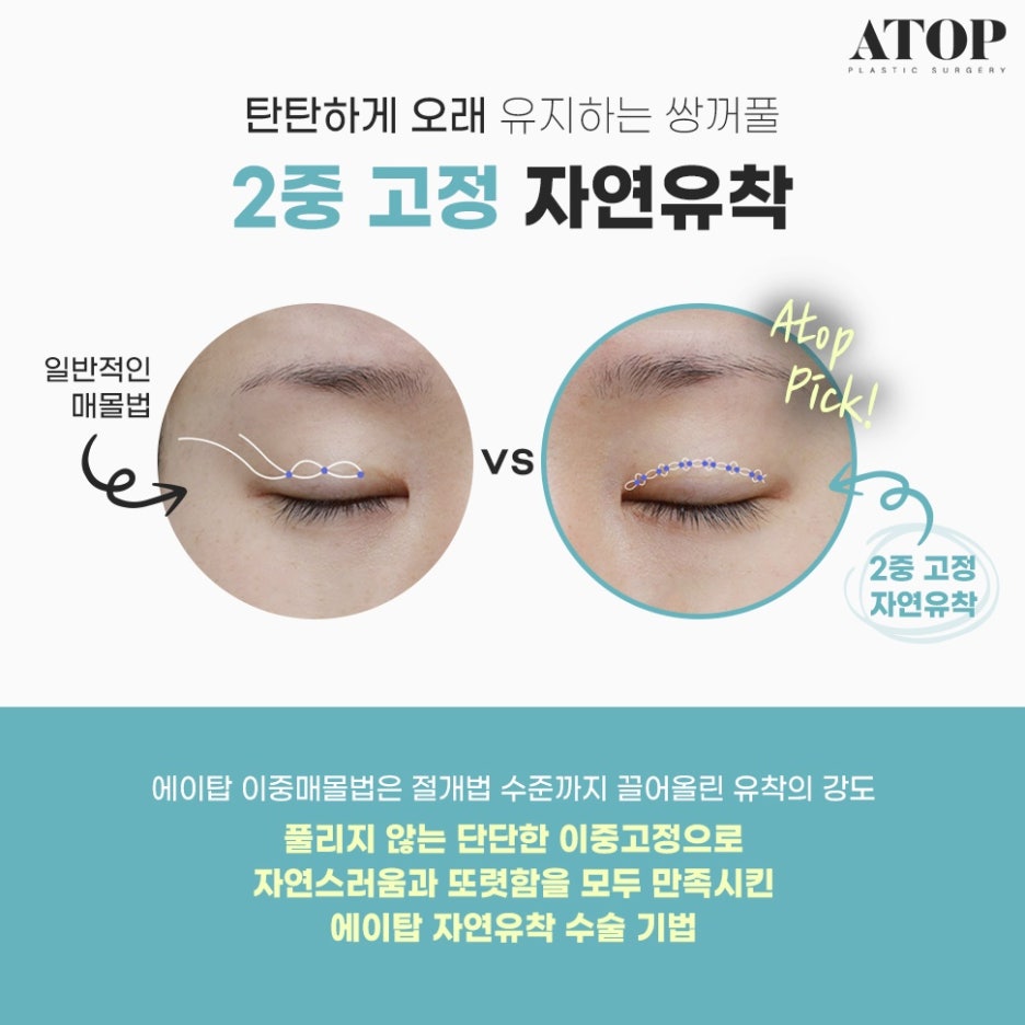 자연유착쌍수후기 인아웃라인 만들기 관련 이미지 3