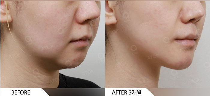 Mini Facelift Lifting That Also Improves Nasolabial Folds: Upgraded Yeo-woo Lifting image 5