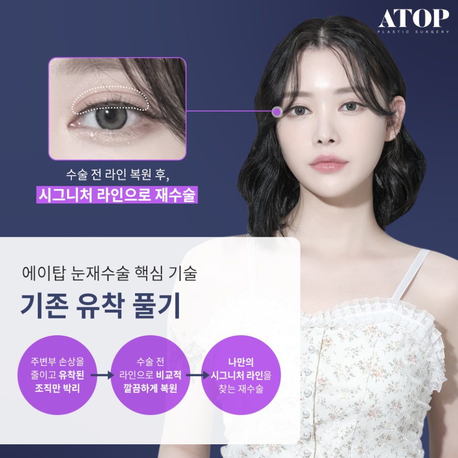 Double Eyelid Revision Surgery Review: No More Repeated Problems image 4