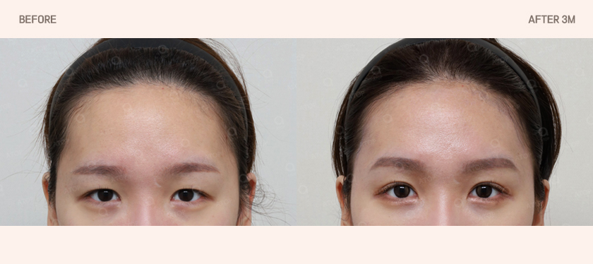 The 5-Point Incisions Remain the Same, but the Dissection Planes Are Different｜Second-Generation Dual-Plane Forehead Lift image 5