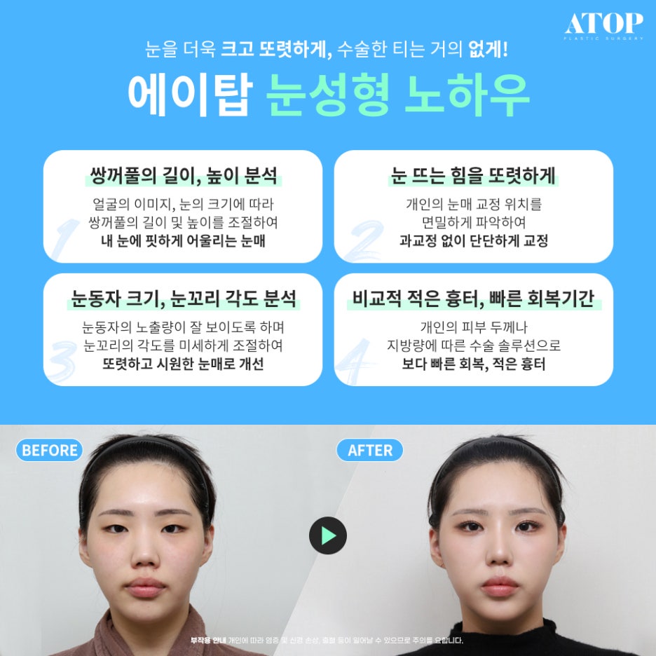 Custom Surgery Focused on Your Eyes: Revision Eyelid Surgery Cost image 6