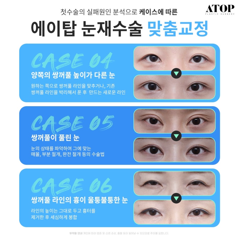 Double Eyelid Revision Surgery, My Own Money, Final Eye Plastic Surgery image 3
