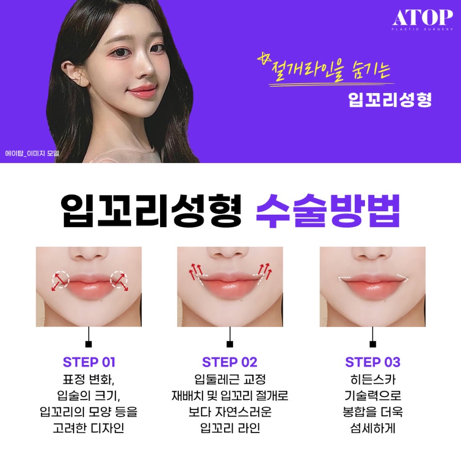 입꼬리수술내돈내산 위치 자체가 교정돼 더 자연스러워 관련 이미지 6
