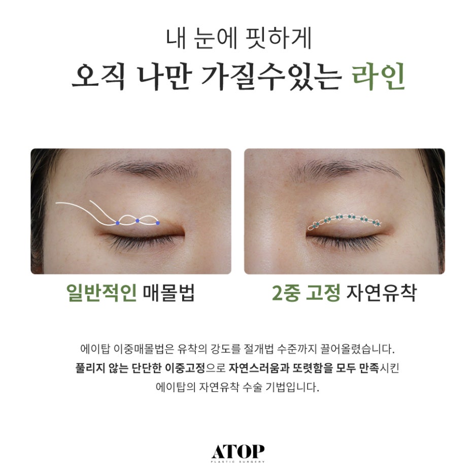 눈코성형비용  이목구비 조화로운 맞춤 디자인으로 관련 이미지 2