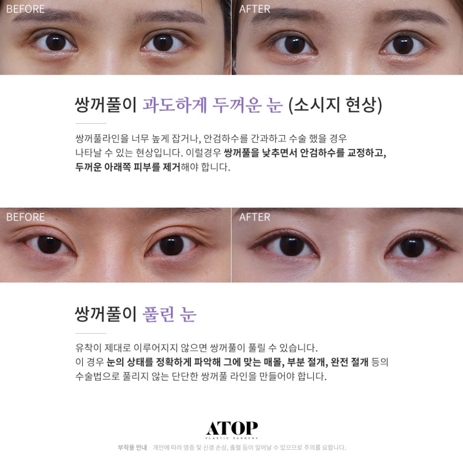 쌍수재수술가격 자연스러운 눈으로 관련 이미지 2