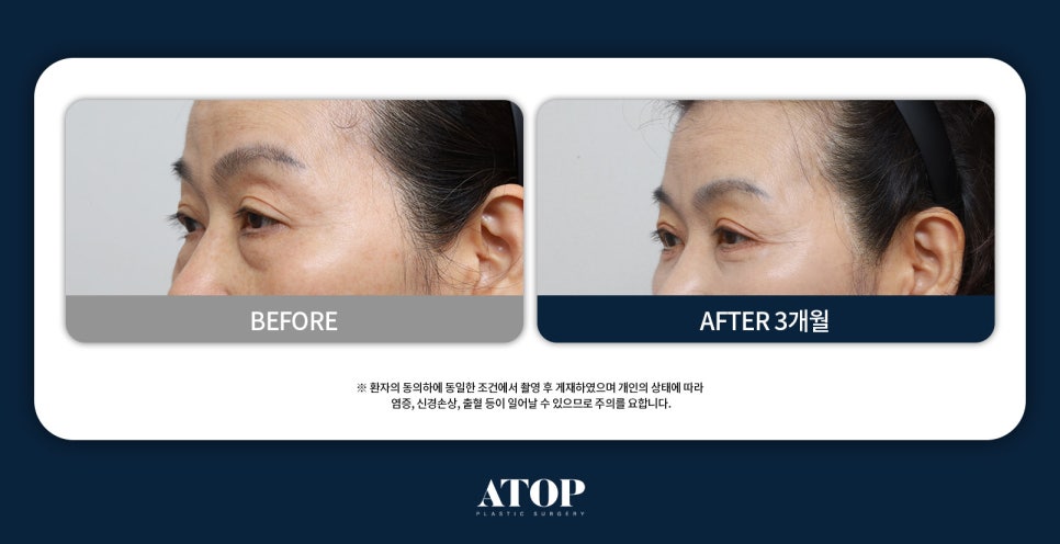 중년 하안검수술 눈밑 주름과 지방 제거에 대한 의료진 설명 관련 이미지 6