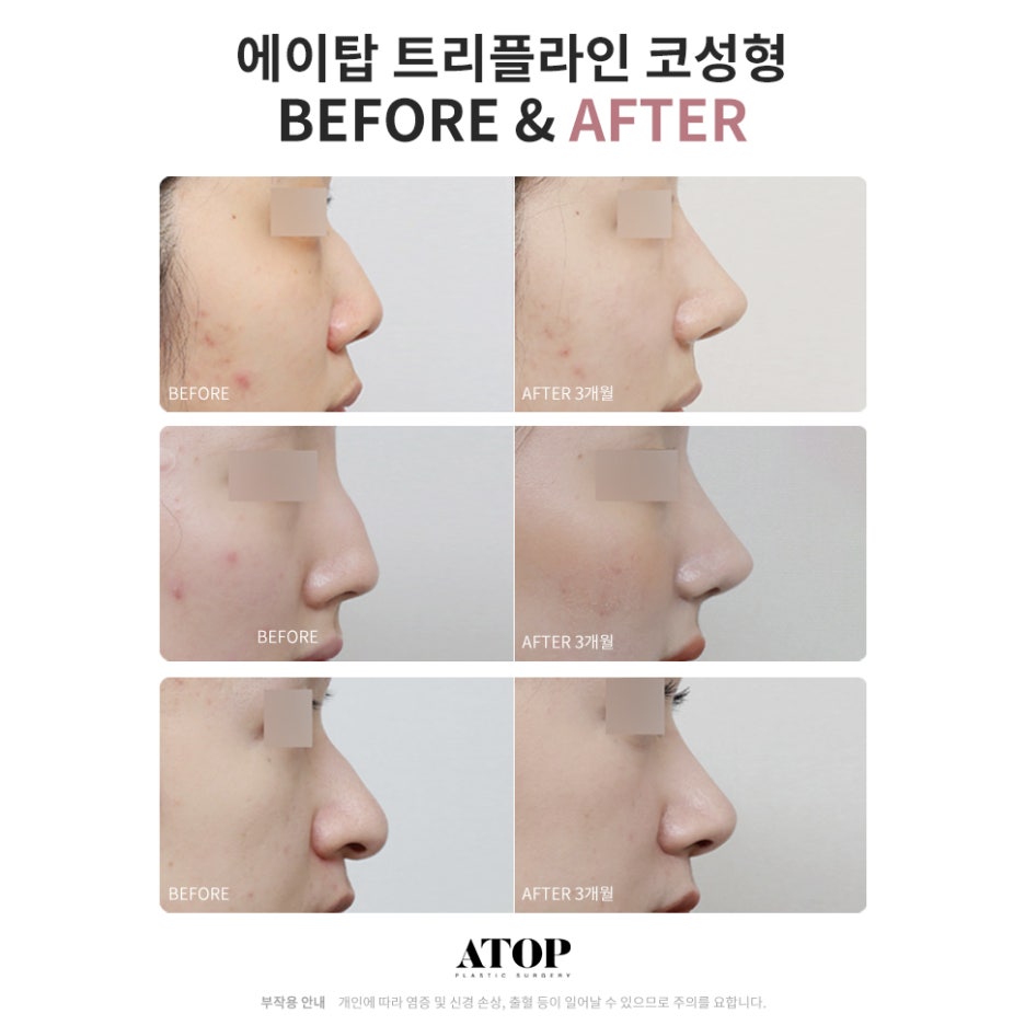 코끝성형비용 제대로 알고 계획해야 관련 이미지 7