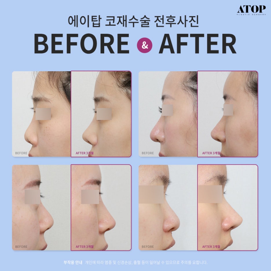 A Deviated Nose Revision Surgery Should Be Different the First Time and the Second Time image 7