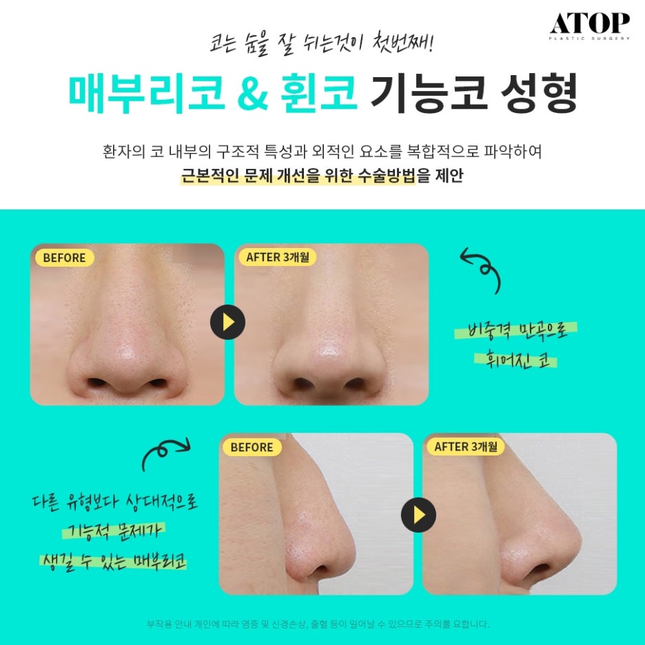 매부리코성형후기 차이나는 이유 관련 이미지 5