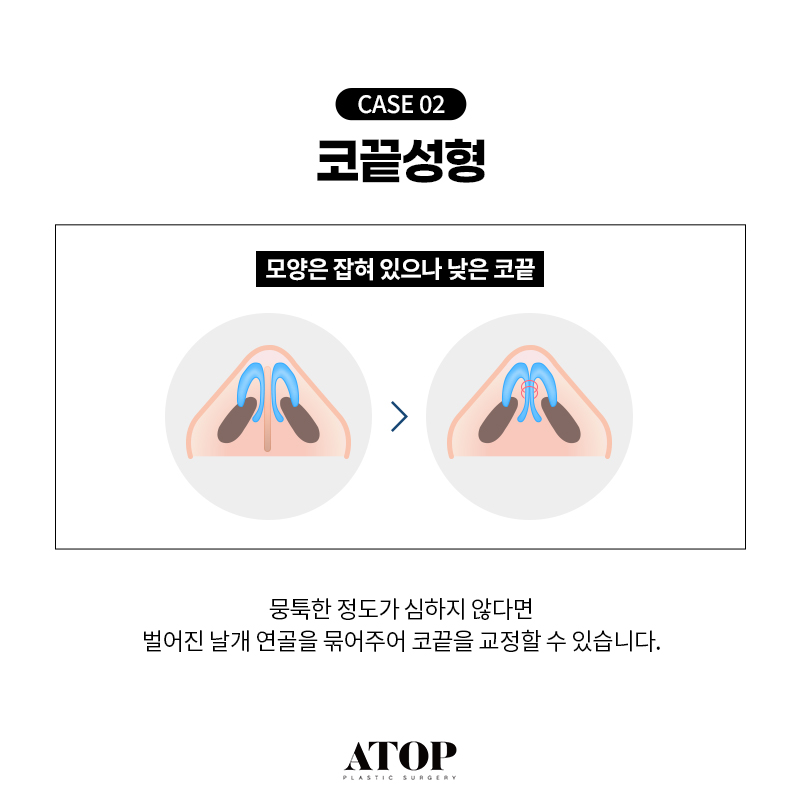 비중격연골 코끝수술 장단점, 의료진의 연골 선택 기준 관련 이미지 5