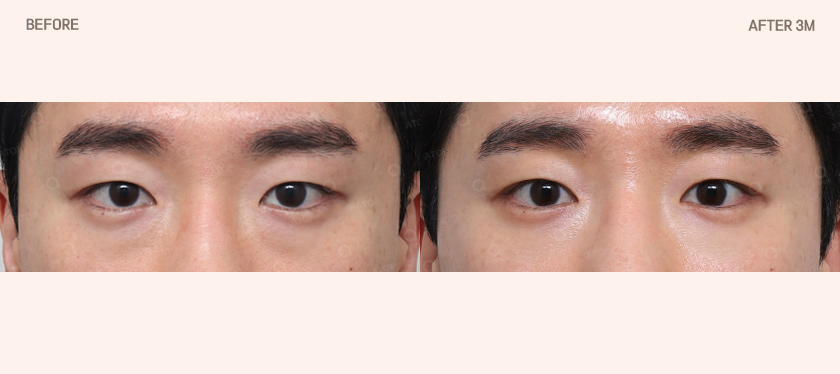 Is Lower Eyelid Fat Repositioning Surgery Simply About Removing Fat? image 1