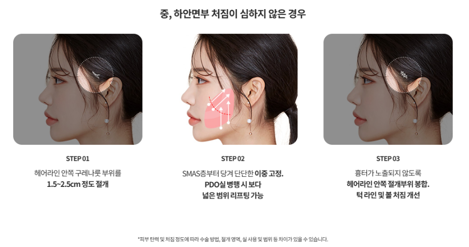 Mini Facelift Lifting That Also Improves Nasolabial Folds: Upgraded Yeo-woo Lifting image 1