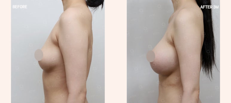 가슴수술, 보형물과 절개 방법까지 나에게 맞게 선택하려면 관련 이미지 5