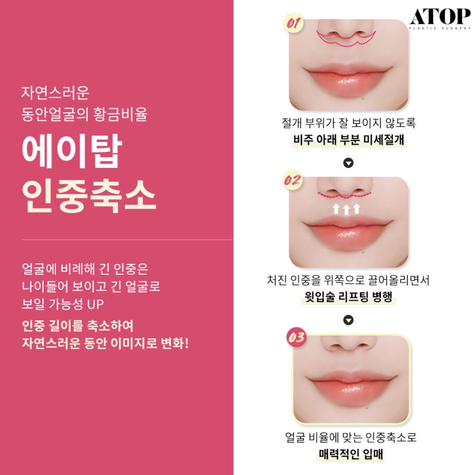 입꼬리수술잘하는곳 러블리한 입매가 될 수 있게 관련 이미지 5