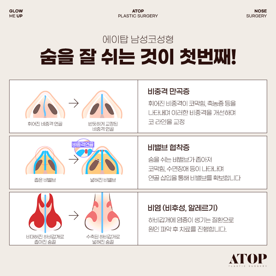 기능코성형, 코 모양은 물론 숨길을 함께 고려해야 하는 이유 관련 이미지 5