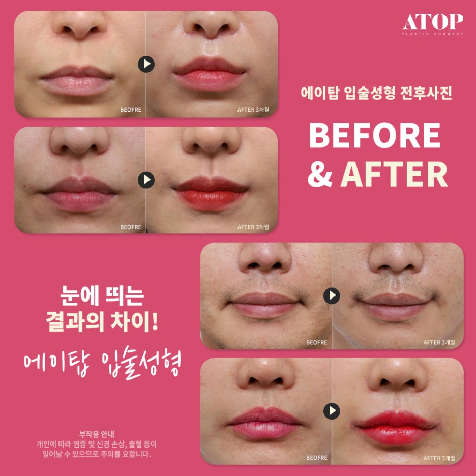 입꼬리수술잘하는곳 러블리한 입매가 될 수 있게 관련 이미지 7