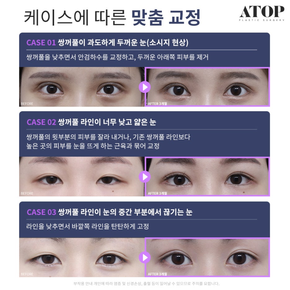 Double Eyelid Revision Surgery Review: No More Repeated Problems image 2