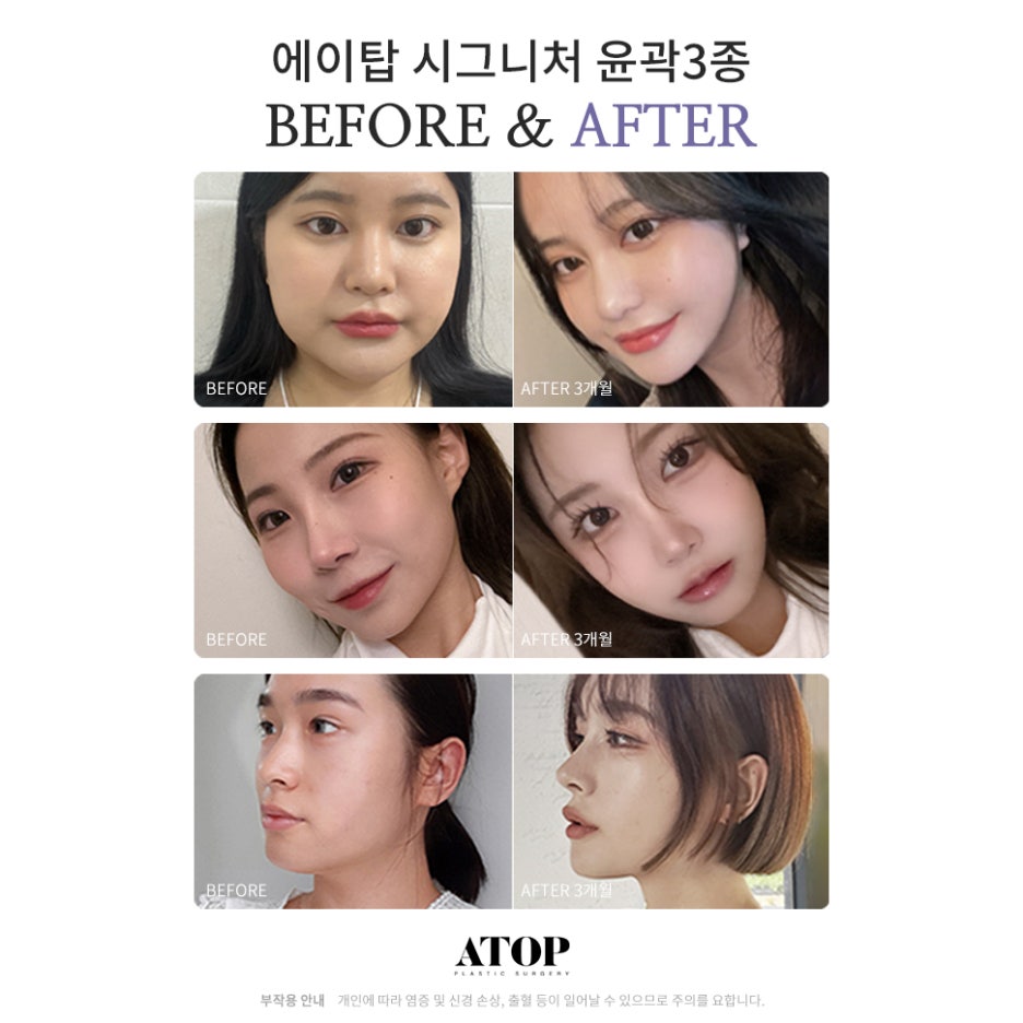 무턱보형물수술 자연스럽게 이어지는 윤곽 라인 관련 이미지 7