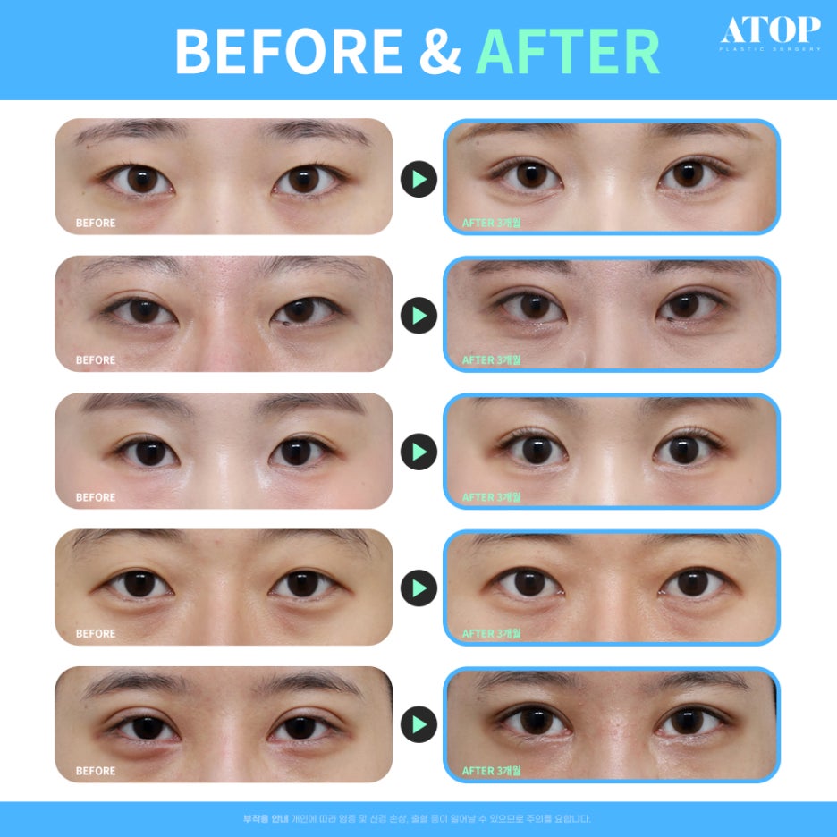Custom Surgery Focused on Your Eyes: Revision Eyelid Surgery Cost image 7