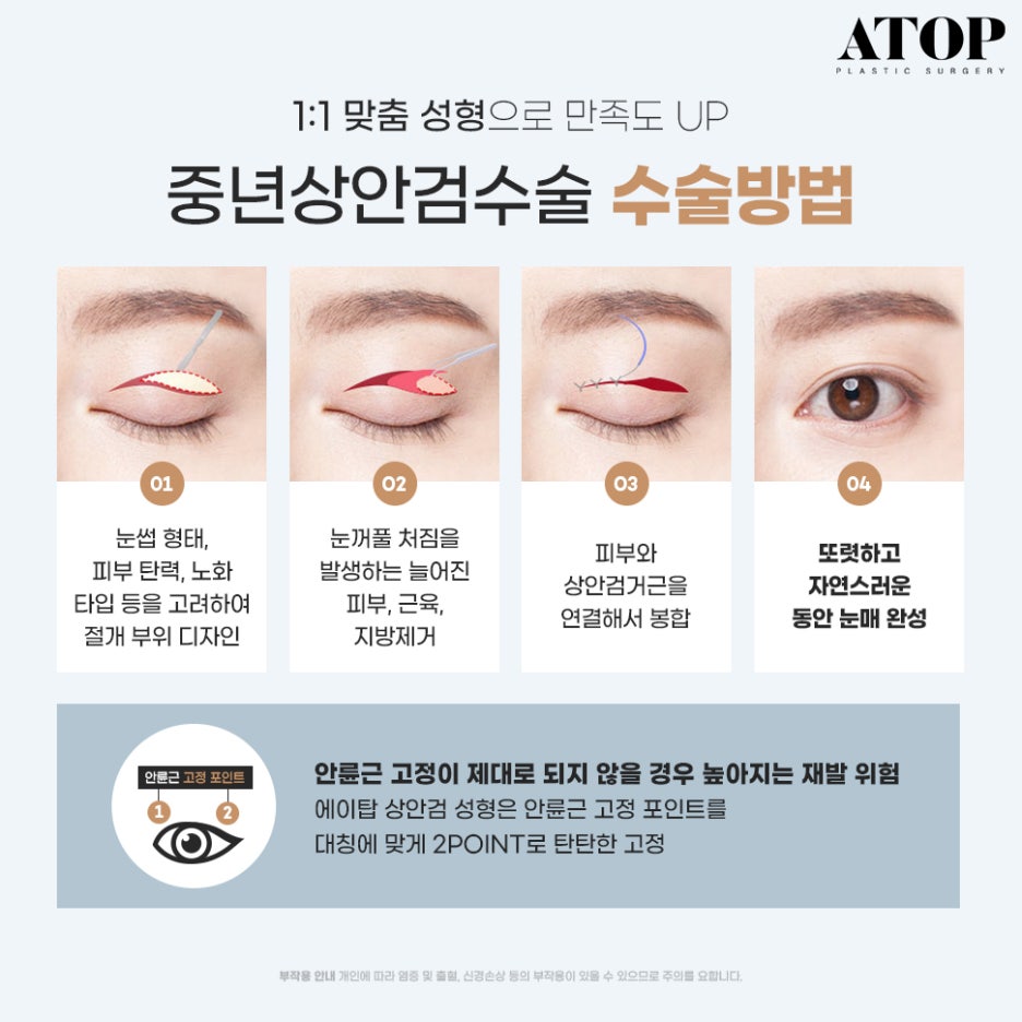 중년눈밑지방 눈꺼풀이 계속 처진다면? 관련 이미지 3