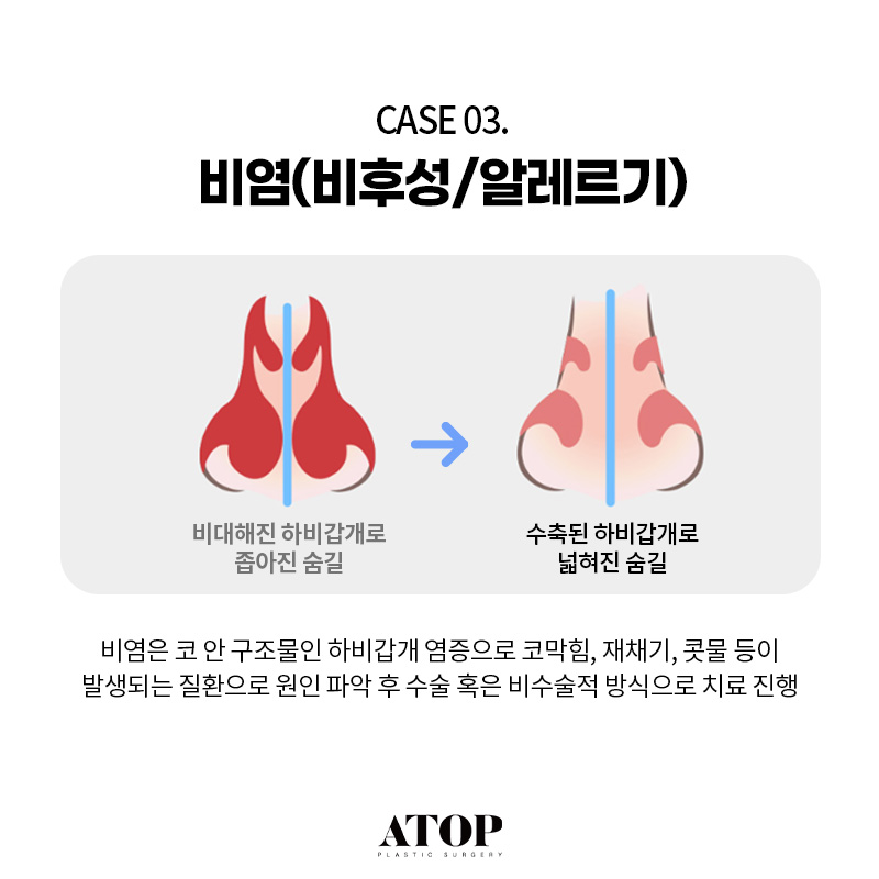 기능코성형수술로 해결할 수 있는 질환은? 관련 이미지 5