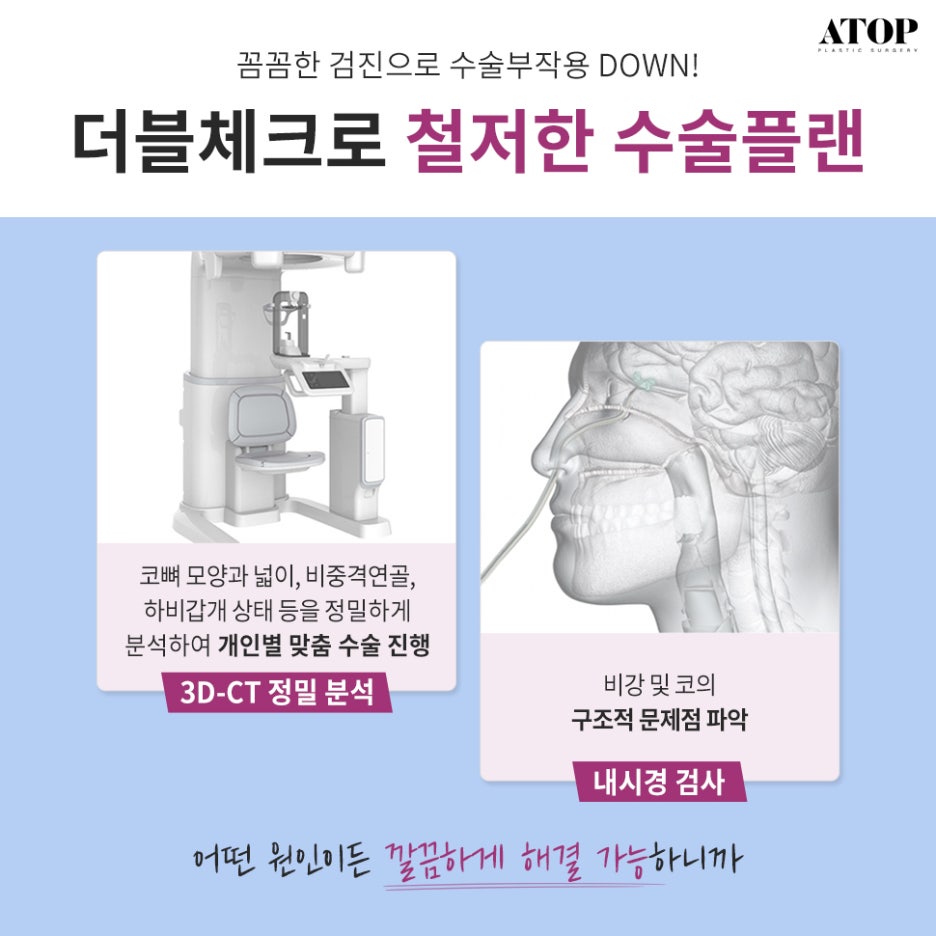 A Deviated Nose Revision Surgery Should Be Different the First Time and the Second Time image 6