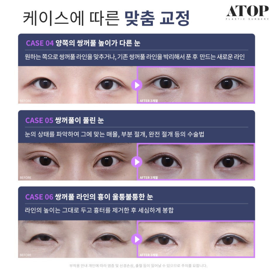Double Eyelid Revision Surgery Review: No More Repeated Problems image 3