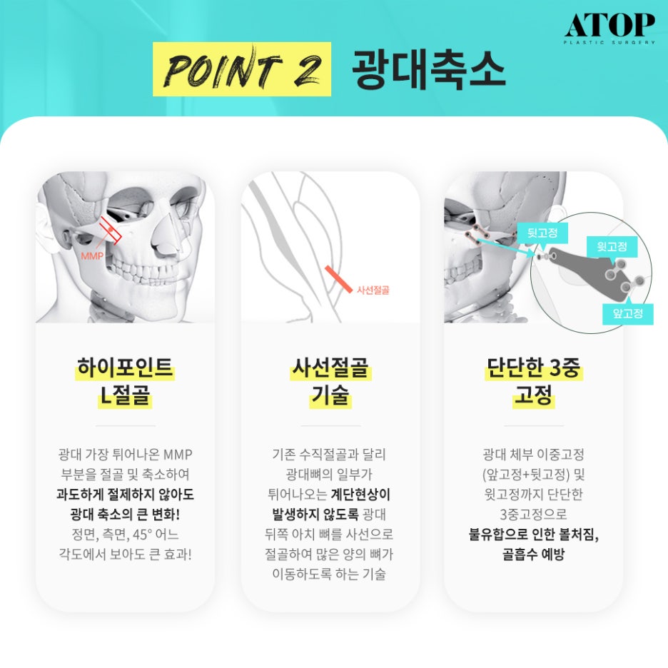 광대축소후기 크고 울퉁불퉁한 얼굴형 개선 관련 이미지 4