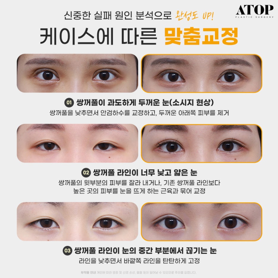 눈재수술병원 내 눈에 집중한 맞춤 수술 관련 이미지 2