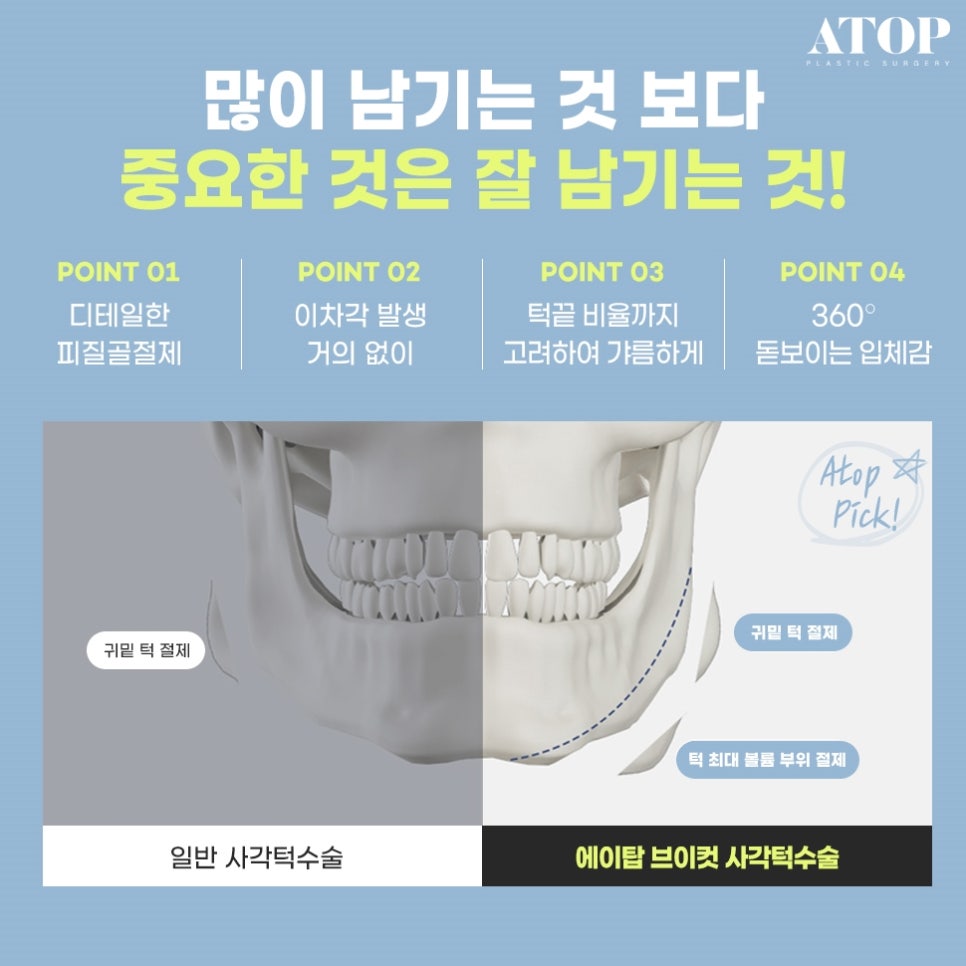 남자사각턱수술 중점적으로 봐야 하는 점 관련 이미지 3