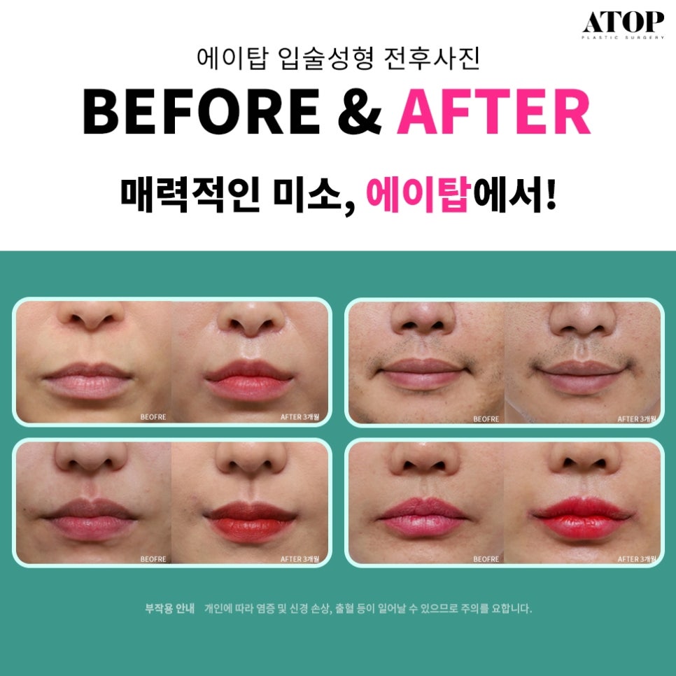 Gangnam Mouth Corner Surgery So Your Lips Match the Look You Want image 7