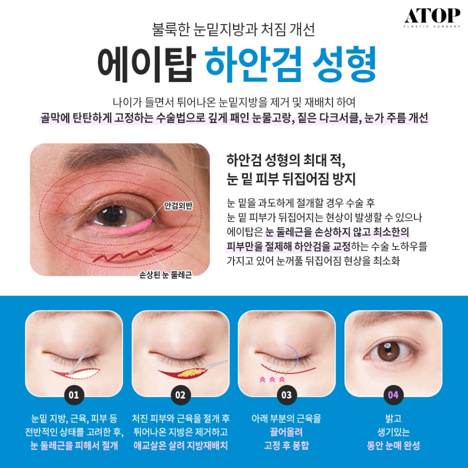 처진눈수술 중년의 눈을 또렷하게 관련 이미지 5
