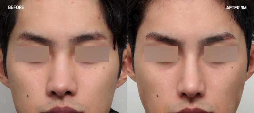 기능코성형, 코 모양은 물론 숨길을 함께 고려해야 하는 이유 관련 이미지 6