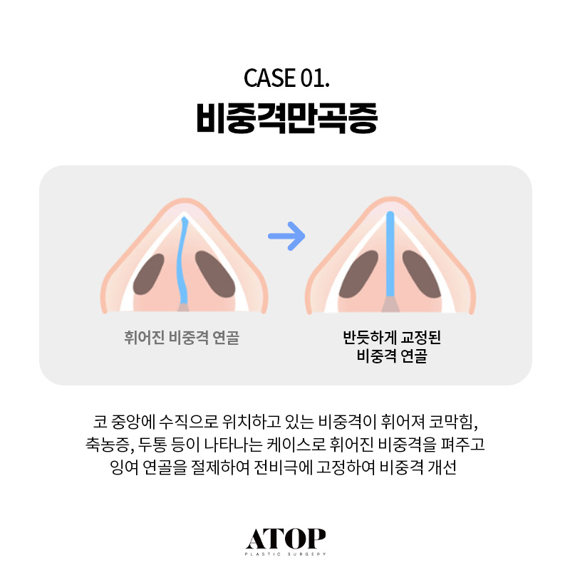 기능코성형수술로 해결할 수 있는 질환은? 관련 이미지 3