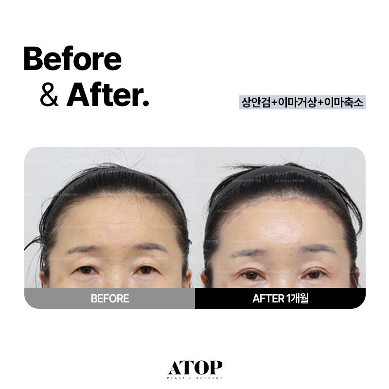 내시경 이마거상, 이마축소 같이 하는게 좋은 이유 / 에이탑성형외과 권준성 원장 칼럼 관련 이미지 6