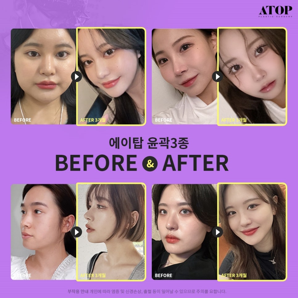 Gangnam Facial Contouring 3-in-1: A Soft, Smooth Line image 7
