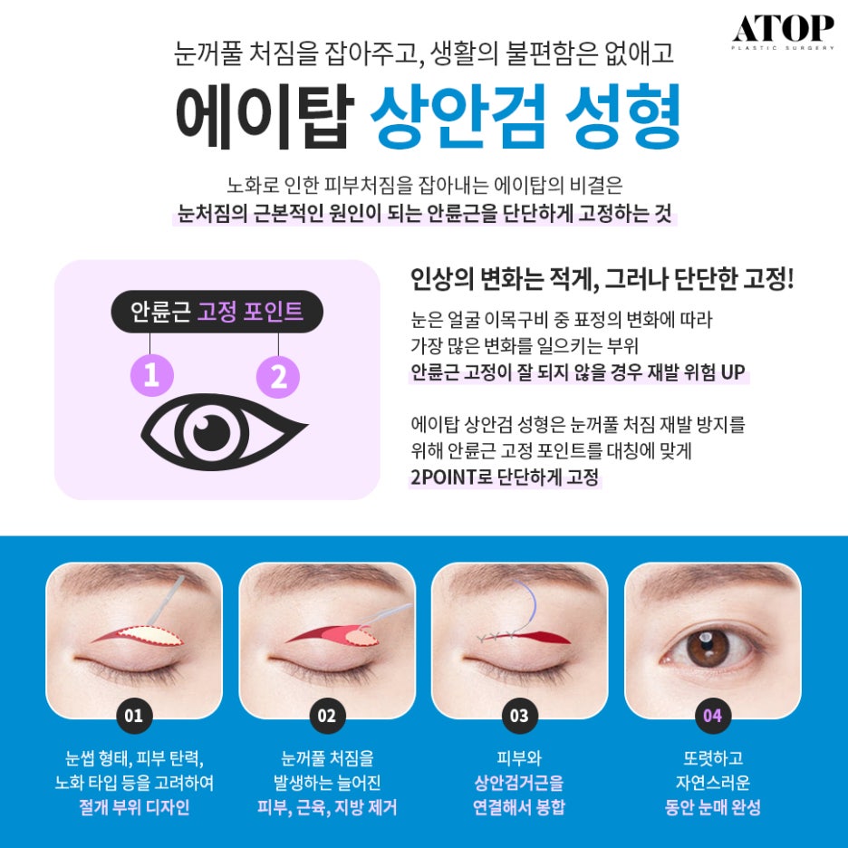 처진눈수술 중년의 눈을 또렷하게 관련 이미지 4