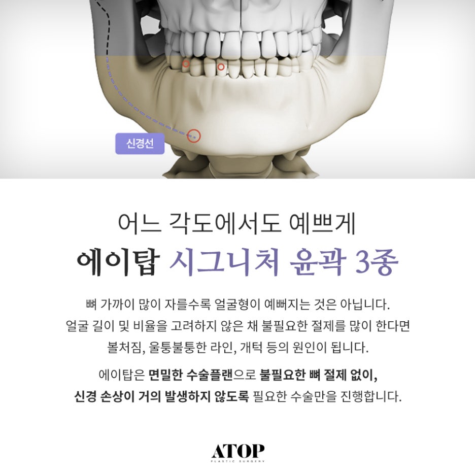 무턱보형물수술 자연스럽게 이어지는 윤곽 라인 관련 이미지 2