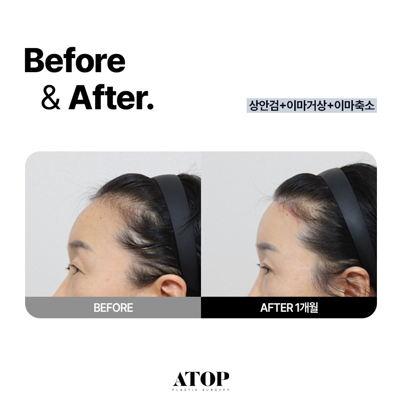내시경 이마거상, 이마축소 같이 하는게 좋은 이유 / 에이탑성형외과 권준성 원장 칼럼 관련 이미지 5