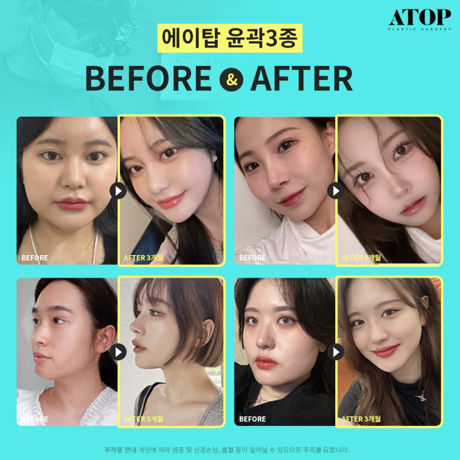 광대축소후기 크고 울퉁불퉁한 얼굴형 개선 관련 이미지 7