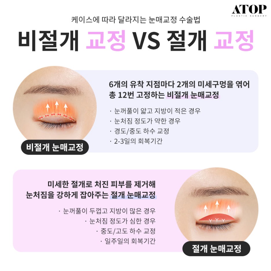 Natural Adhesion Double Eyelid Review: Confidence Boosted with a Face-Fitting Procedure image 6