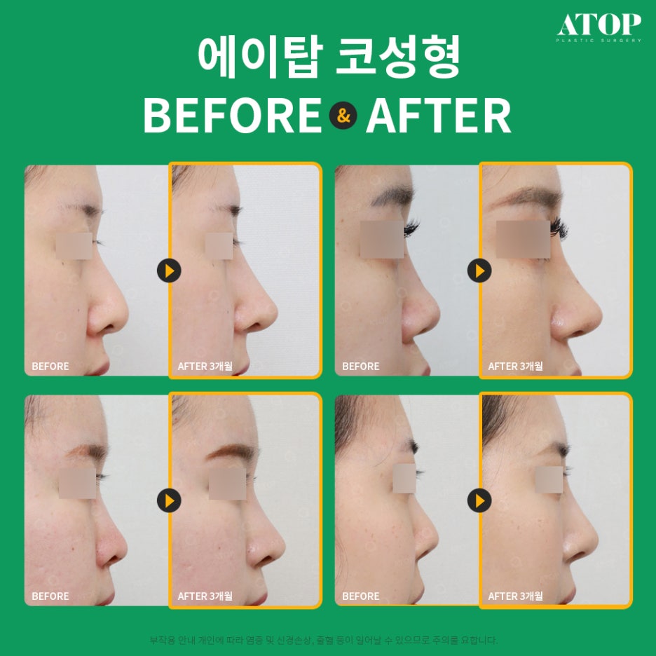 To Avoid Worrying About Scars from Closed Rhinoplasty image 7